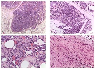 Rare solid tumors in a patient with Wiskott–Aldrich syndrome after hematopoietic stem cell transplantation: case report and review of literature
